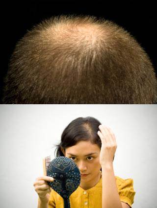 Hair Loss